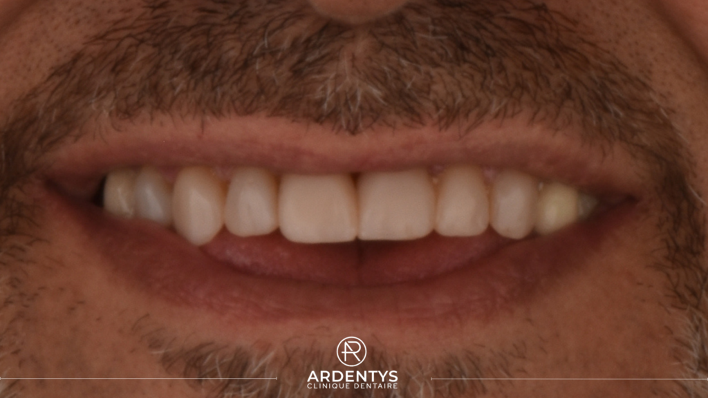 Prothèses Dentaires