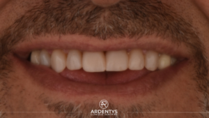 Prothèses Dentaires